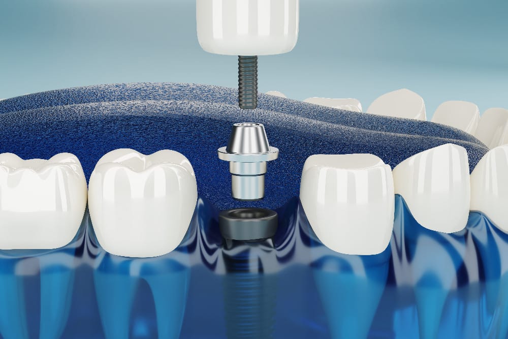 Dental Implants