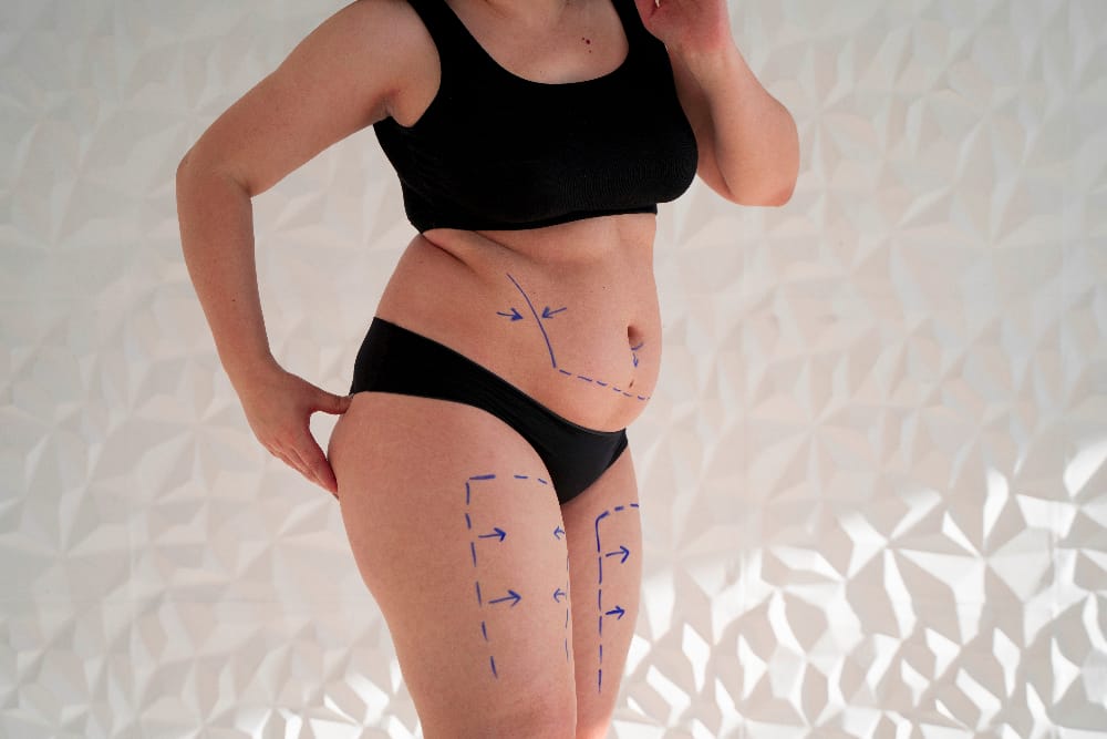 Tumescent Liposuction