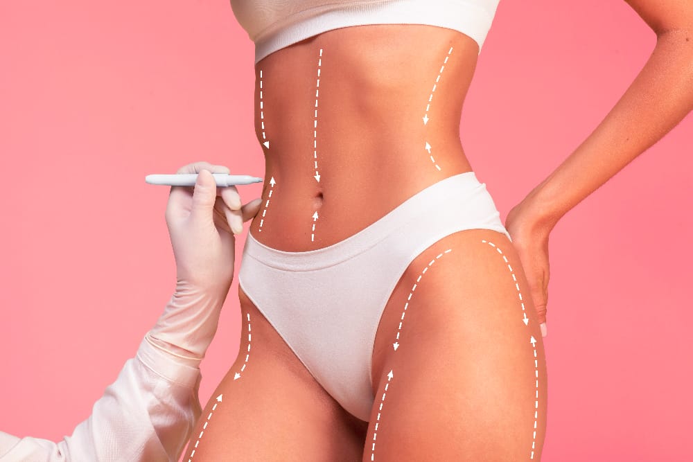 VASER liposuction