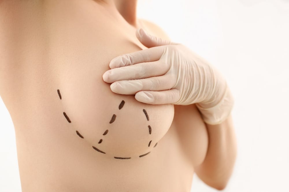 breast lift