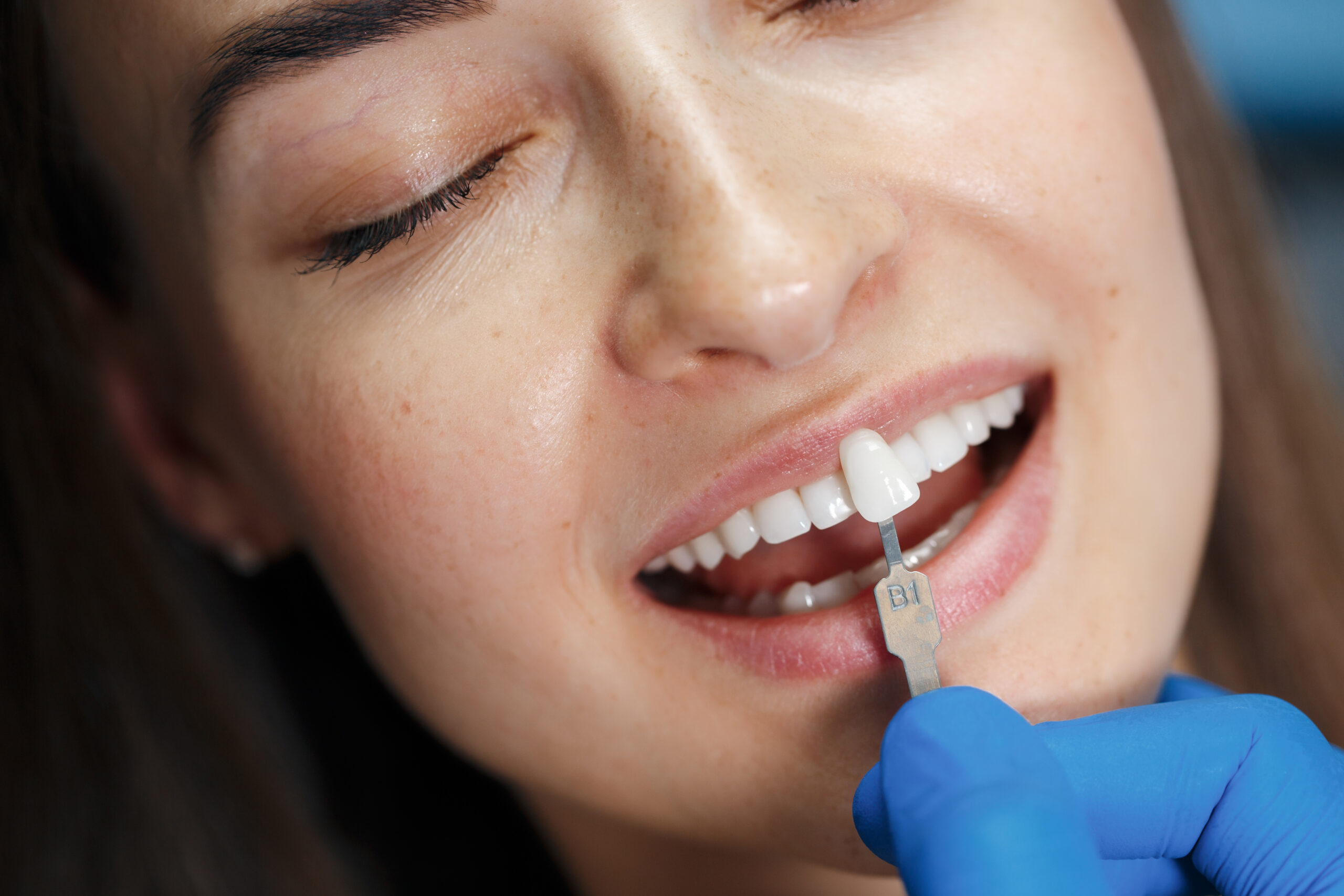 Porcelain Veneers in Turkey: Quality, Cost, and Experience